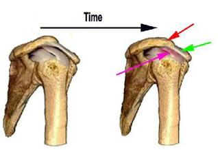 inflamación del manguito rotador