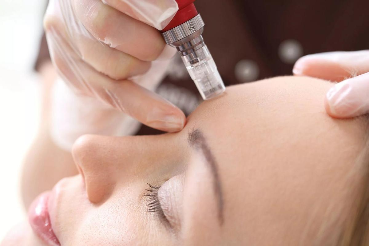 MICRONEEDLING STILLNESS