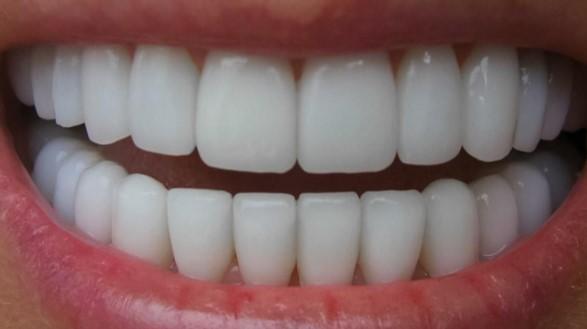Tratamientos caseros para el blanqueamiento dental: las soluciones que debes conocer 1
