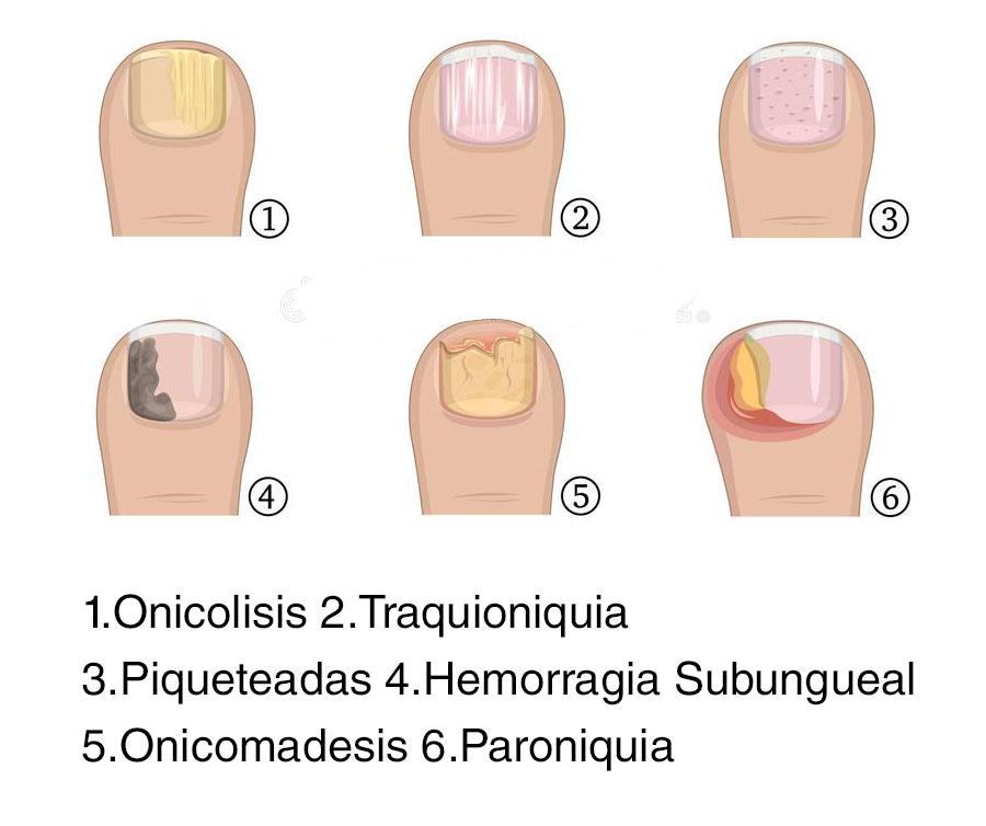 enfermedades de las uñas causadas por alergia