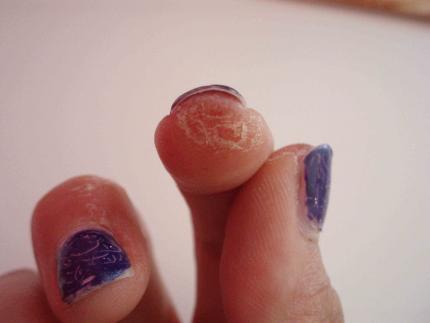 alergia a los productos de uñas