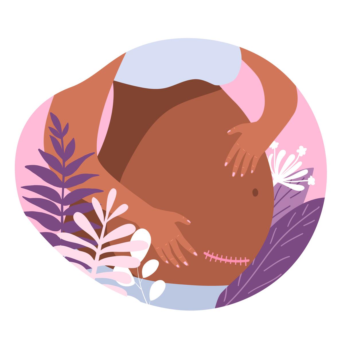 negación del embarazo