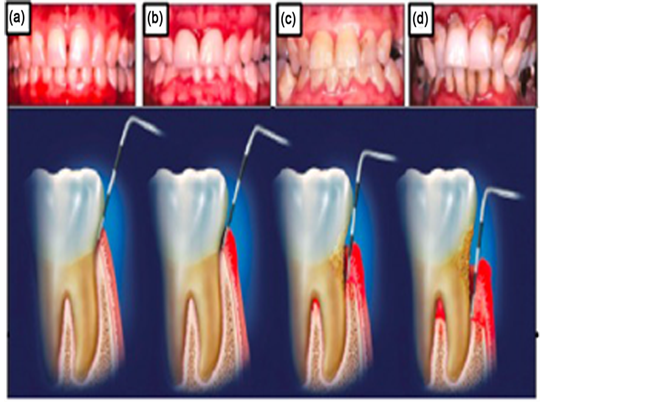 gingivitis y periodontitis