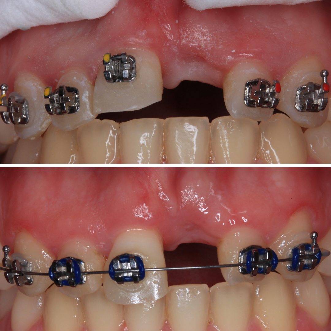 ortodoncia diente incrustado