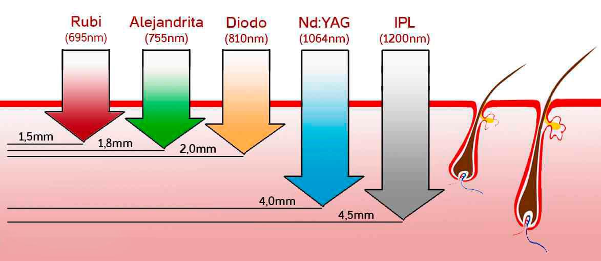 tipos de depilación laser