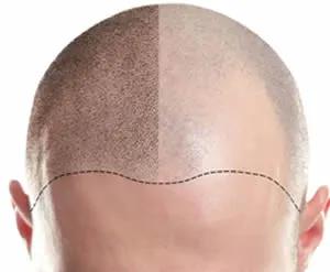 micropigmentacion capilar