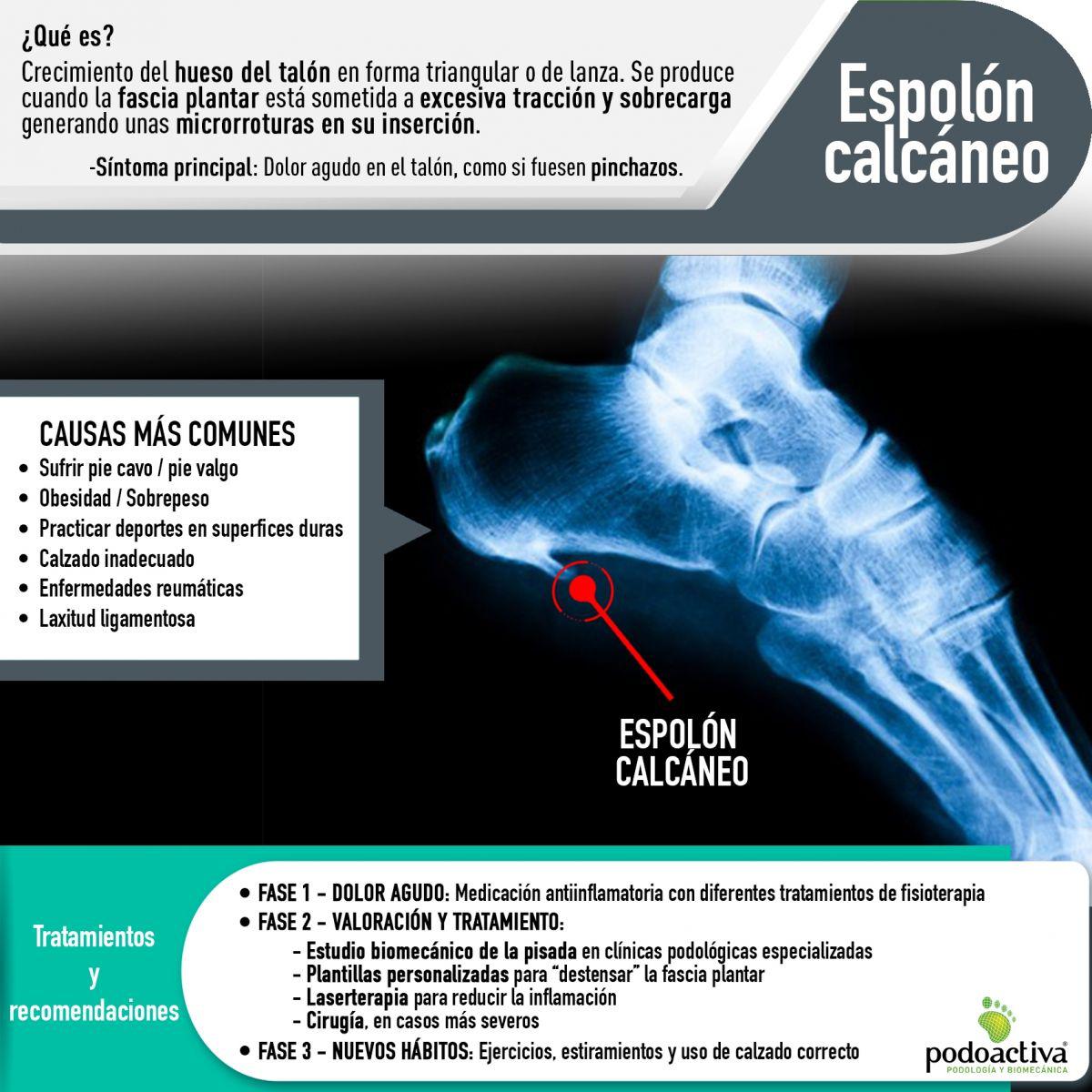espolon calcaneo