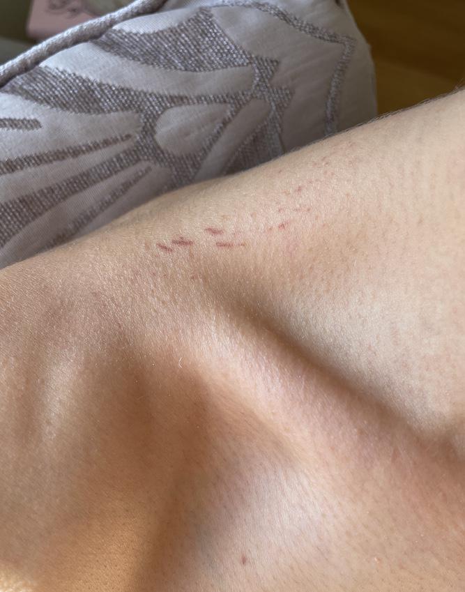 quemadura química por decoloración