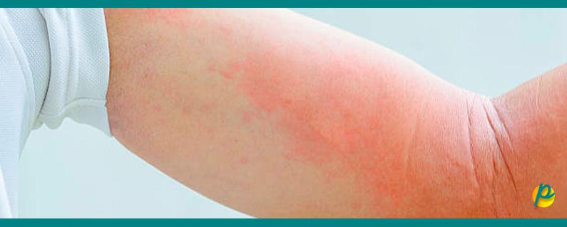 piel-irritada-estres-ansiedad