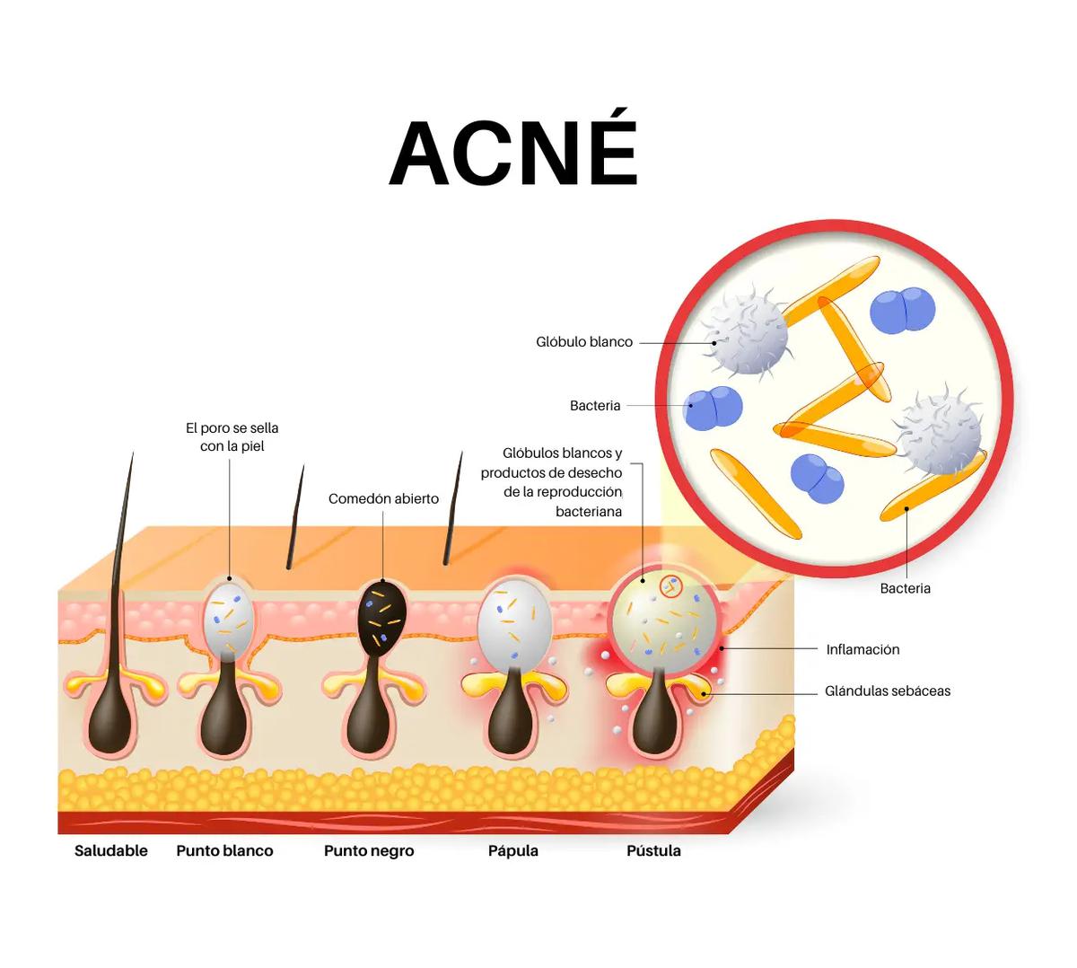 Cómo se forma el acné