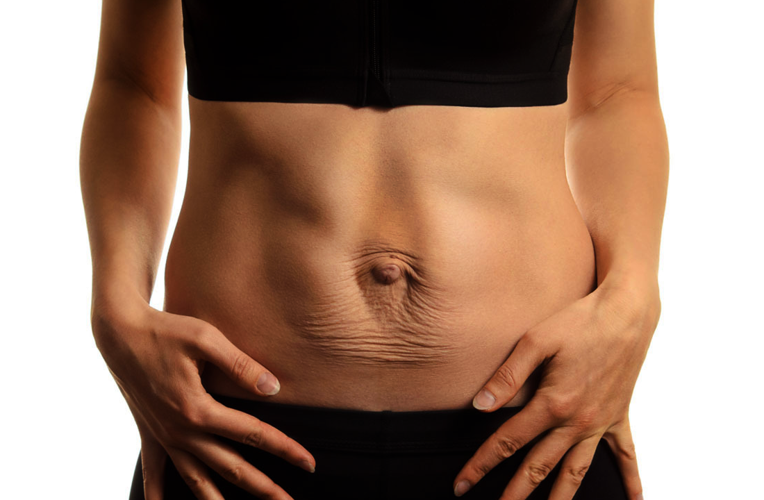 diastasis abdominal