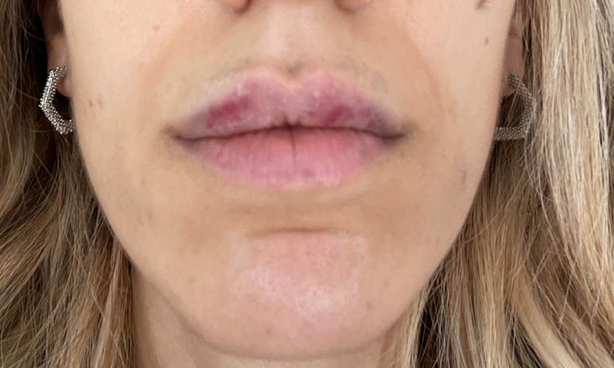 Marzo 2022 - día del primer tratamiento