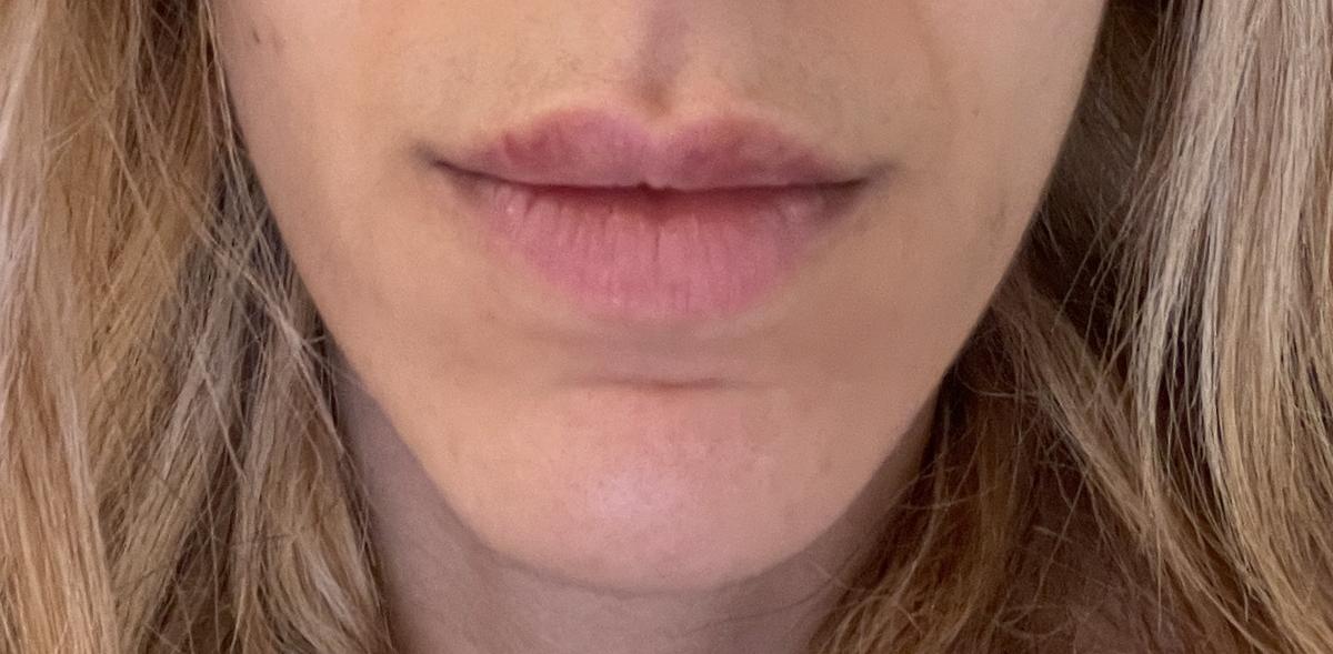 Abril 2022 - una semana después del primer tratamiento