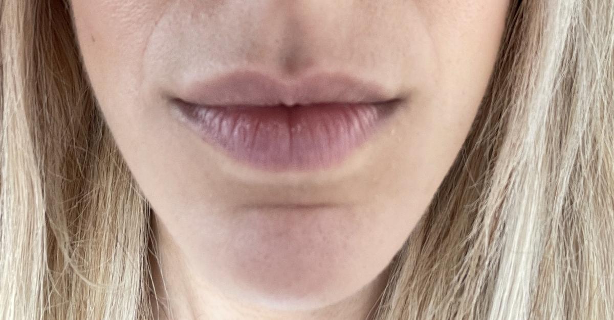 Julio 2022 - antes del segundo tratamiento