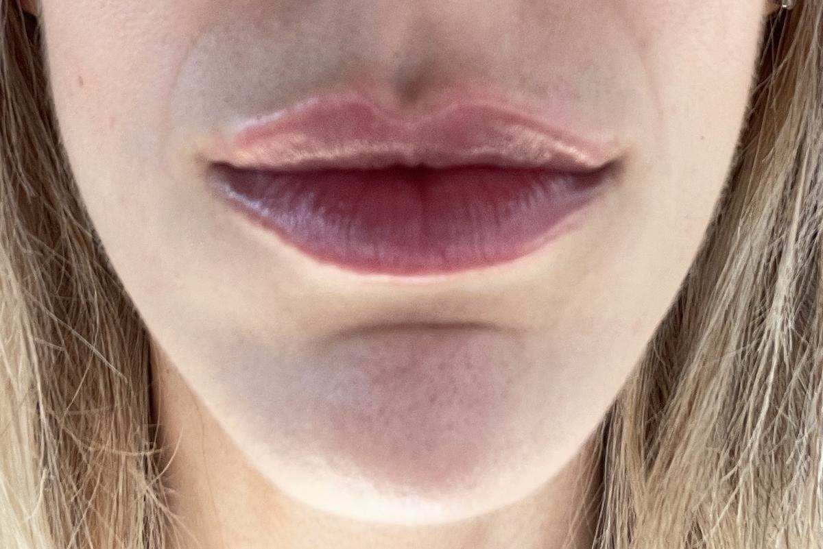 Agosto 2022 - día del segundo tratamiento