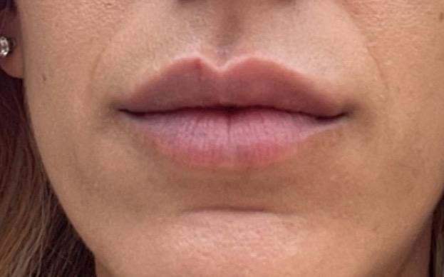 Agosto 2022 - una semana después del segundo tratamientoJPG