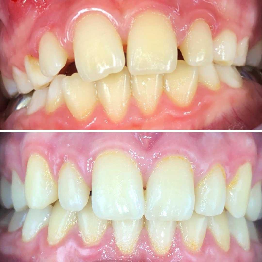 La ortopedia miofuncional corrige la respiración oral y la deglución atípica, malos hábitos que, en muchas ocasiones, son la causa de importantes problemas bucodentales, como paladar estrecho, falta de espacio para la erupción de dientes permanentes (apiñamiento), maloclusión y mordida cruzada. 