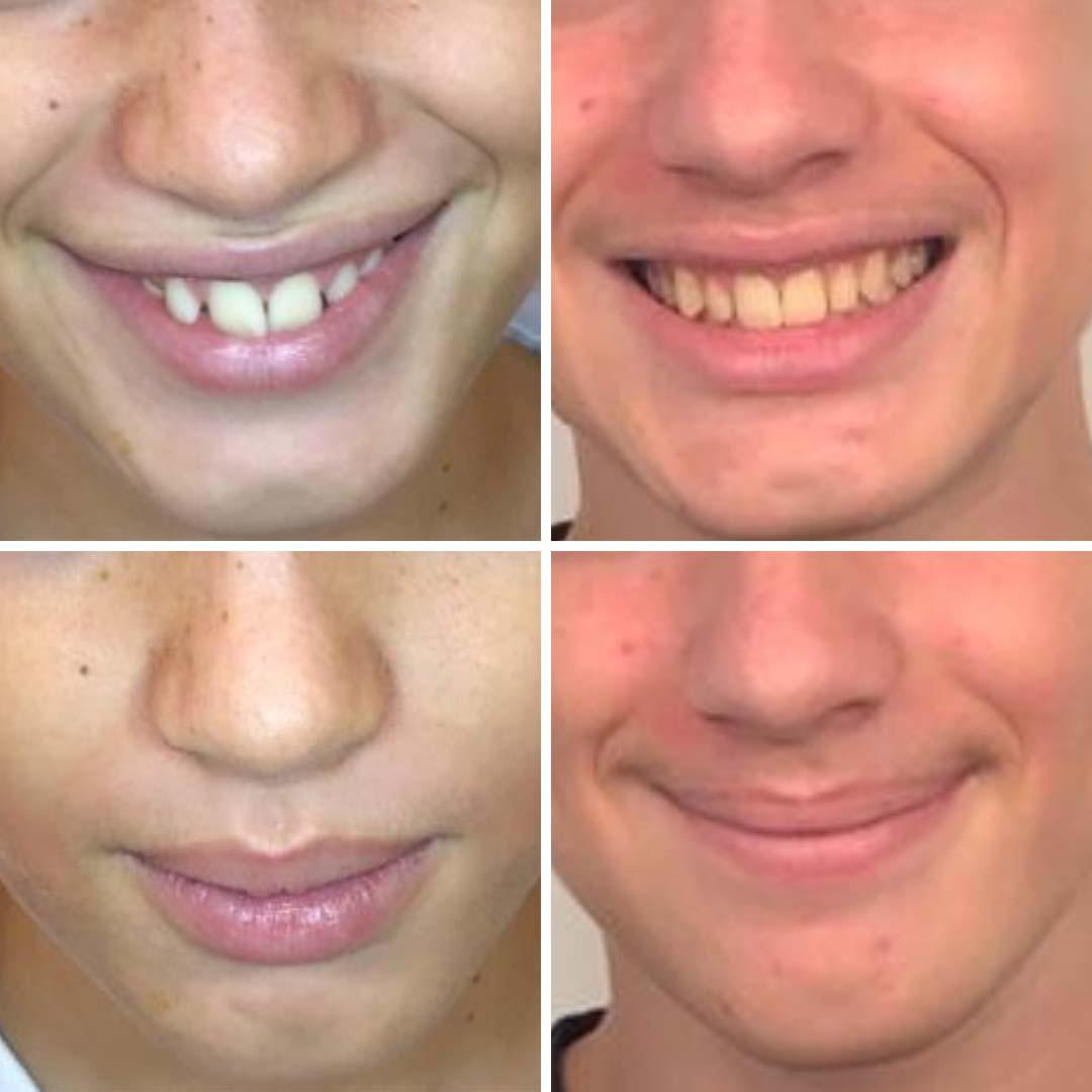 Con la ortopedia miofuncional hemos conseguido fortalecer los músculos a nivel orbicular, corregir hábitos, mejorar el desarrollo del arco y la alineación final de los dientes sin necesidad de recurrir a brackets.