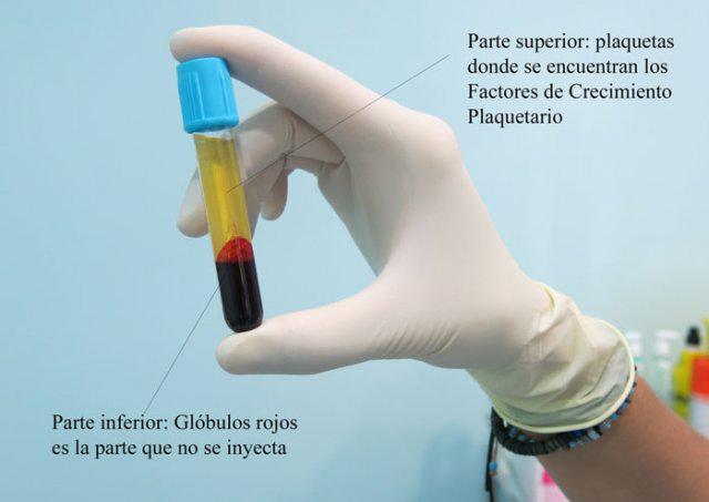 plasma rico en plaquetas