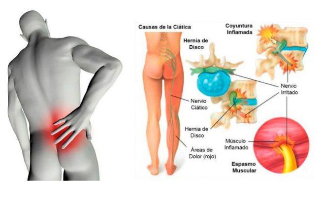 dolor de ciatica