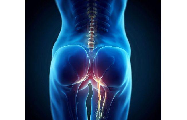 dolor de ciatica