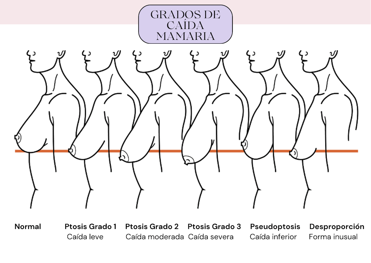 Tipos-caida-mamaria
