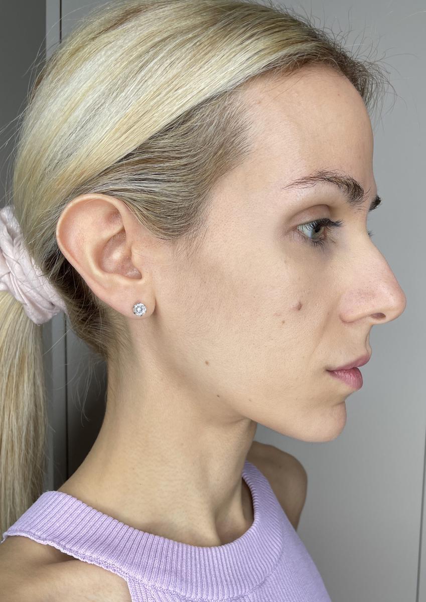 Antes del ZIIP Halo mandíbula