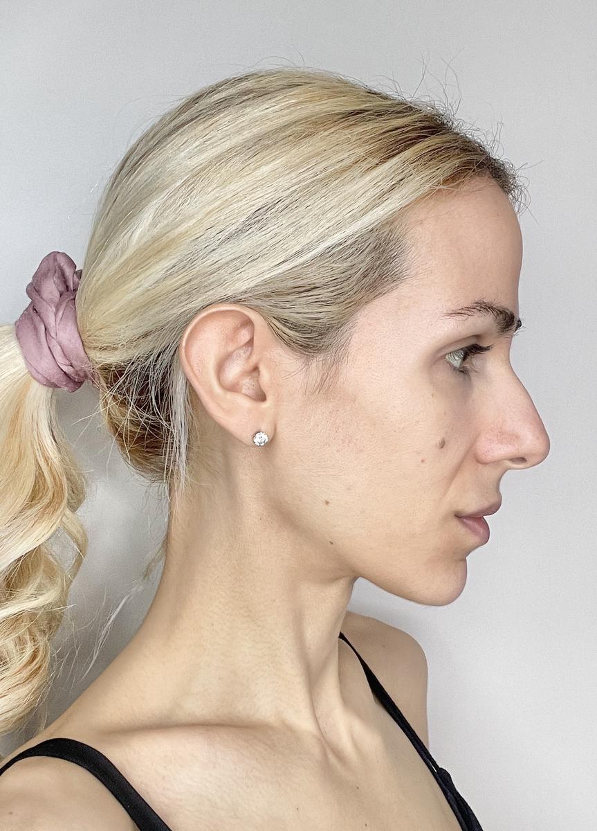 Después del ZIIP Halo mandíbula