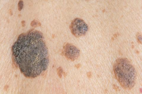 avances en el melanoma