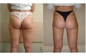 celulitis 2 Trucos para Evitar la Celulitis 