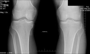Recuperación viable después de una fractura grave de rótula 300x182 Una recuperación viable de una fractura de rótula grave