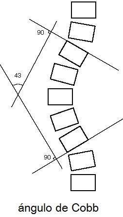 angulo de cobb