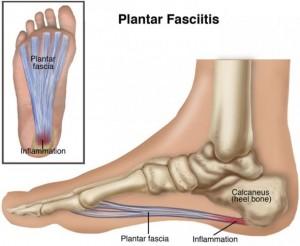 Que es la fascitis 300x246 Fascitis Plantar ¿Qué es? y Ejercicios para Evitar el Dolor