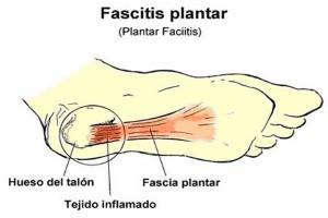 la fascitis plantar 300x200 Fascitis Plantar ¿Qué es? y Ejercicios para Evitar el Dolor