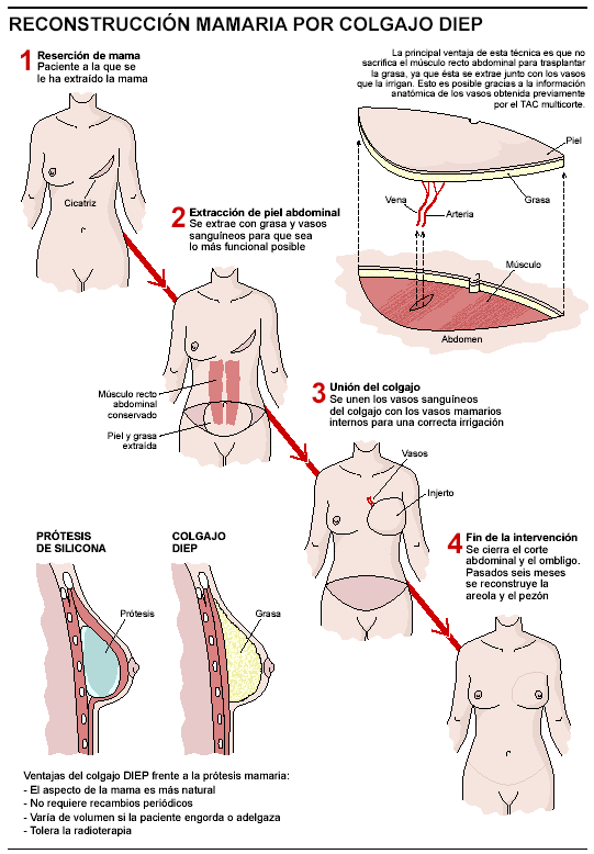 Reconstrucción mamaria técnica DIEP