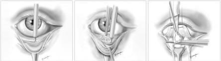 blefaroplastia-inferior-dr.nieto_