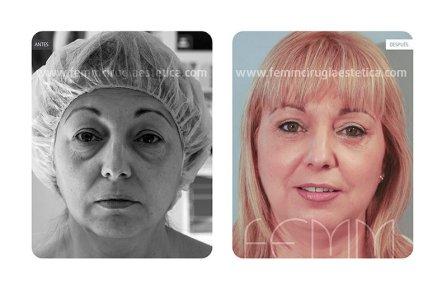 blefaroplastia-caso-clinico-foto-02-b