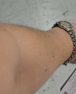 ¿Será un sencillo lunar o acaso un temido melanoma?