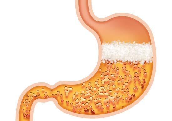 Enfermedad por reflujo gastroesofágico