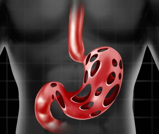 Enfermedad por reflujo gastroesofágico