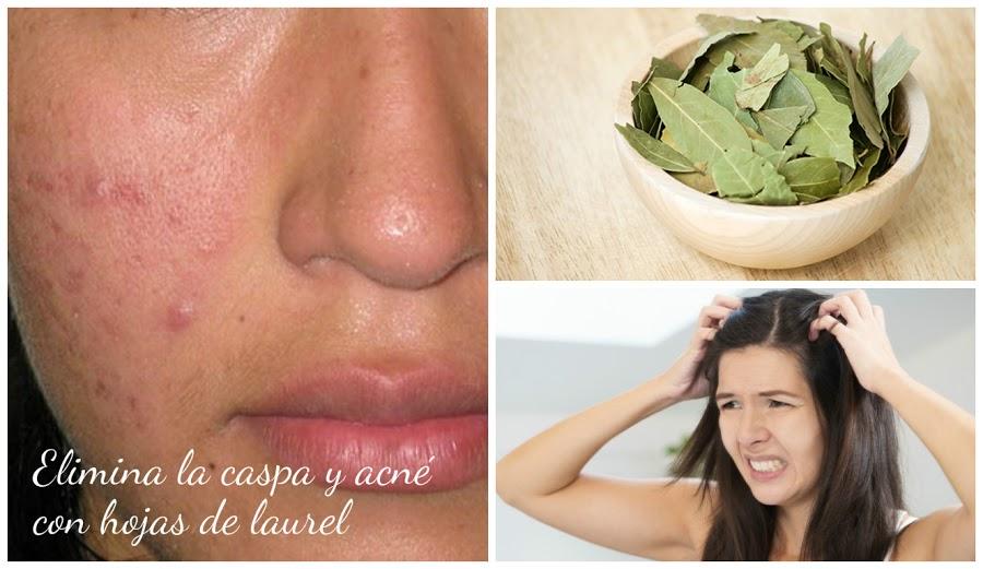 Beneficios de las hojas de laurel para eliminar la caspa y acné Belleza