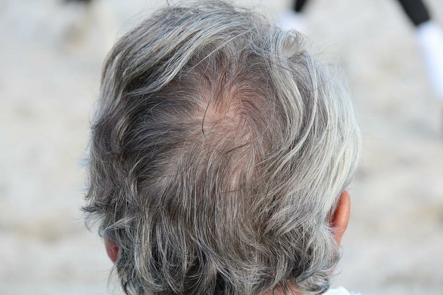 Consejos para prevenir la caída de cabello a temprana edad 