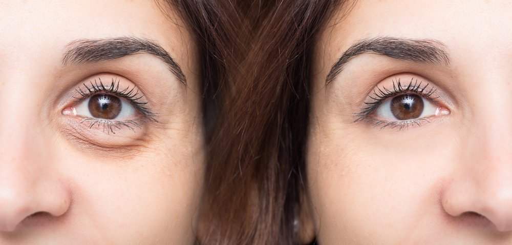 7 trucos para eliminar ojeras y bolsas de ojos