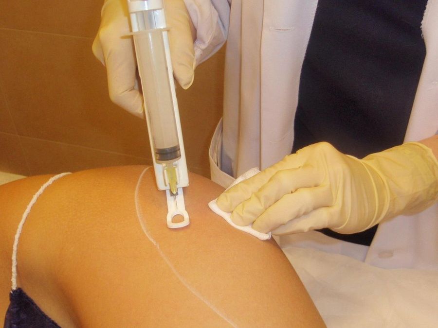 Mesoterapia