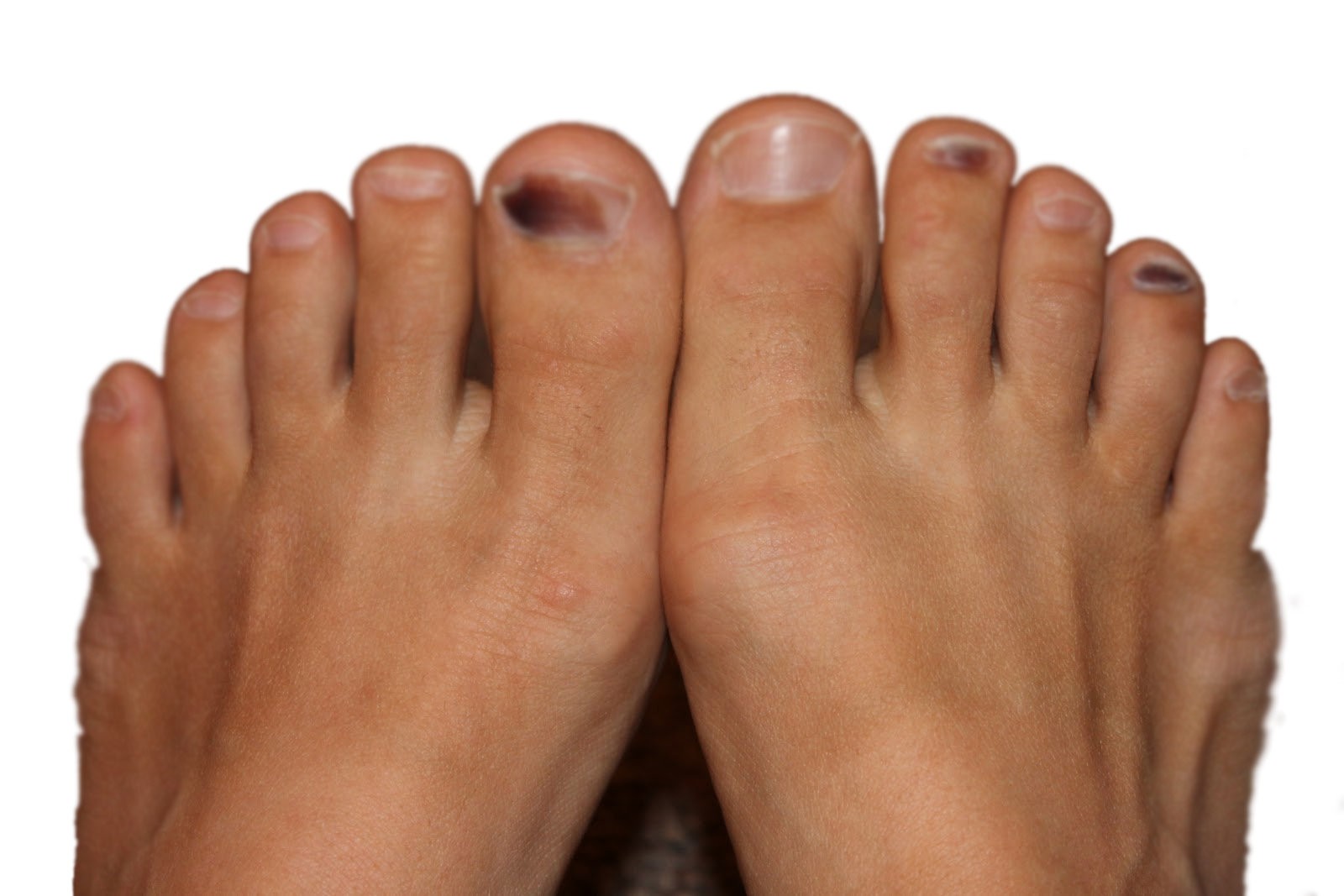 Hongos en pies y manos: 5 remedios naturales efectivos