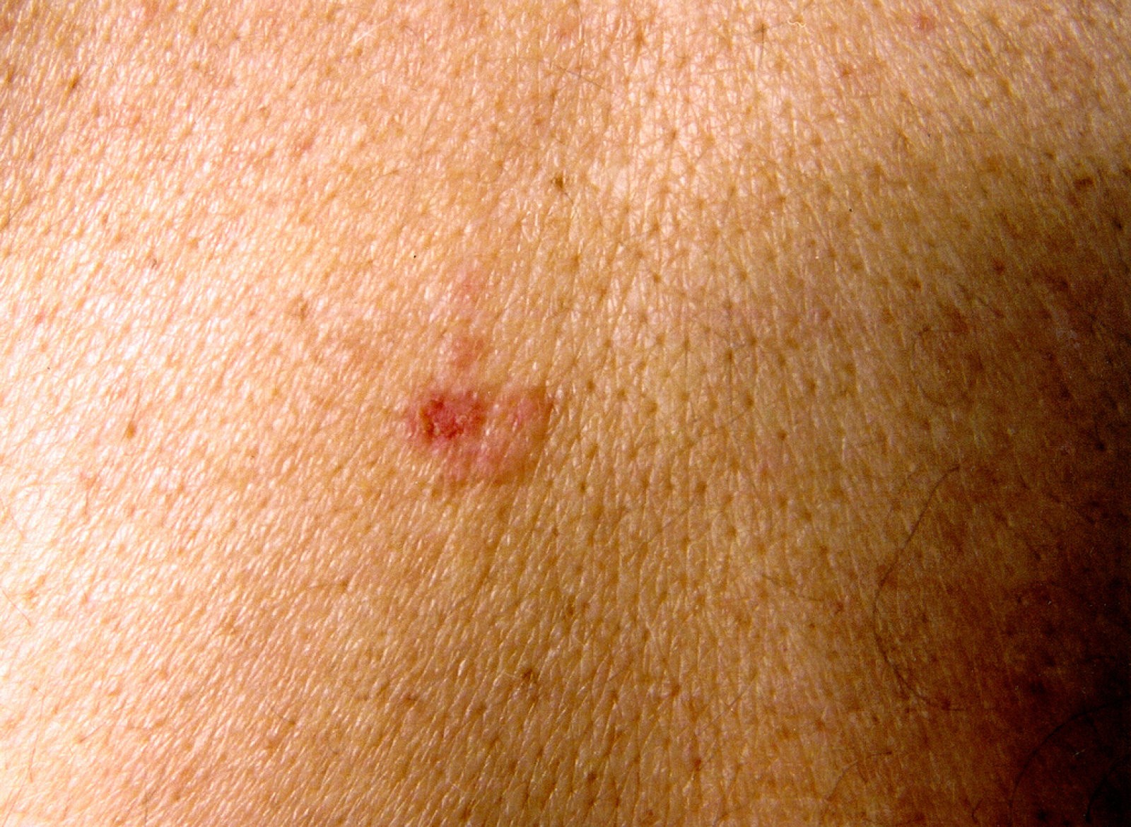 ¿Tienes cáncer de piel? Aprende a detectar los síntomas