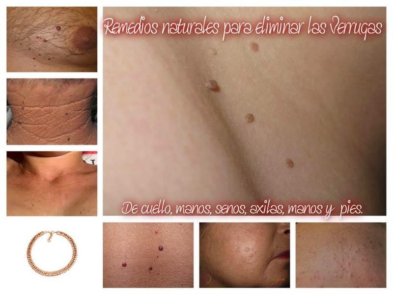 Porque salen verrugas en las axilas y cuello